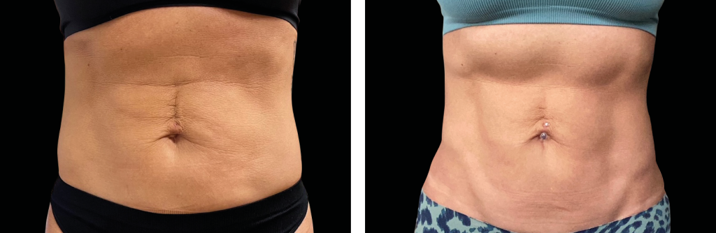 Why Emsculpt is the Best Abdominal Toning and Strengthening