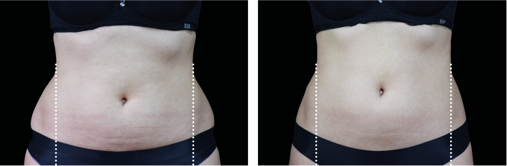 I Tried Emsculpt—a Body-Contouring Device—and Now I Have Actual Abs