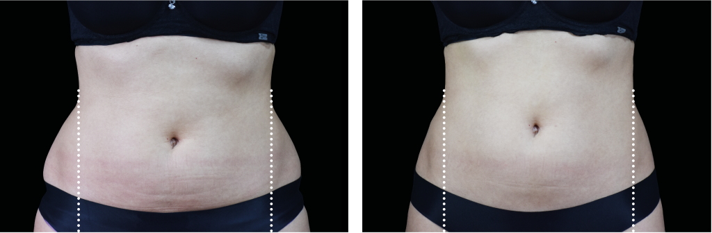 Emsculpt NEO for Abs & Abdomen Before & After