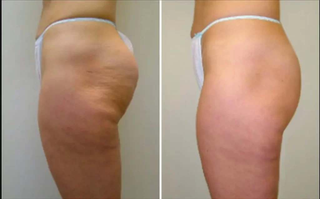 Cellulite Relief Massage: Legs, Bum, Tum