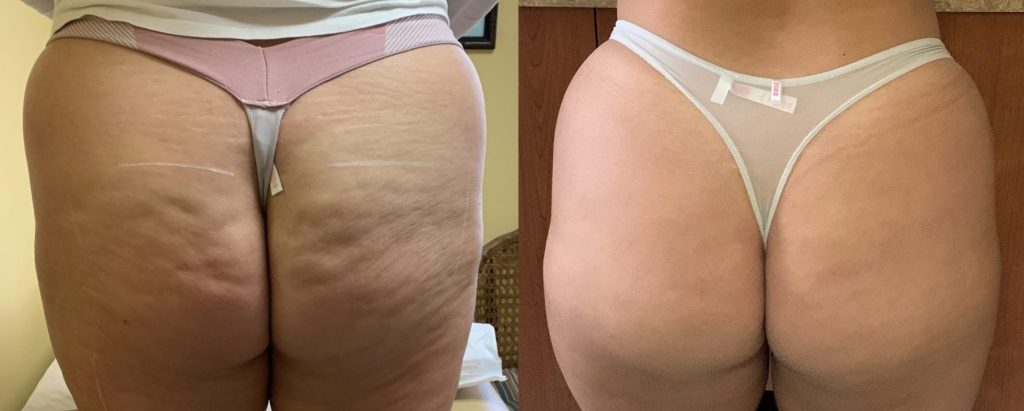 The Three Dimensions of Evolve X: Fat Reduction, Muscle Toning, and Skin  Tightening - LT Men's Clinic