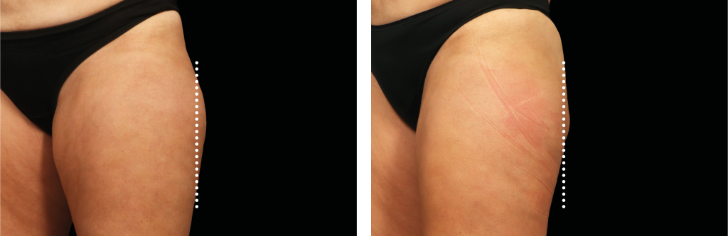 10 SmoothShapes Anti-Cellulite Treatments