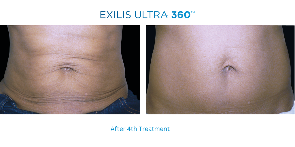 EXILIS Stomach Skin Tightening - £99