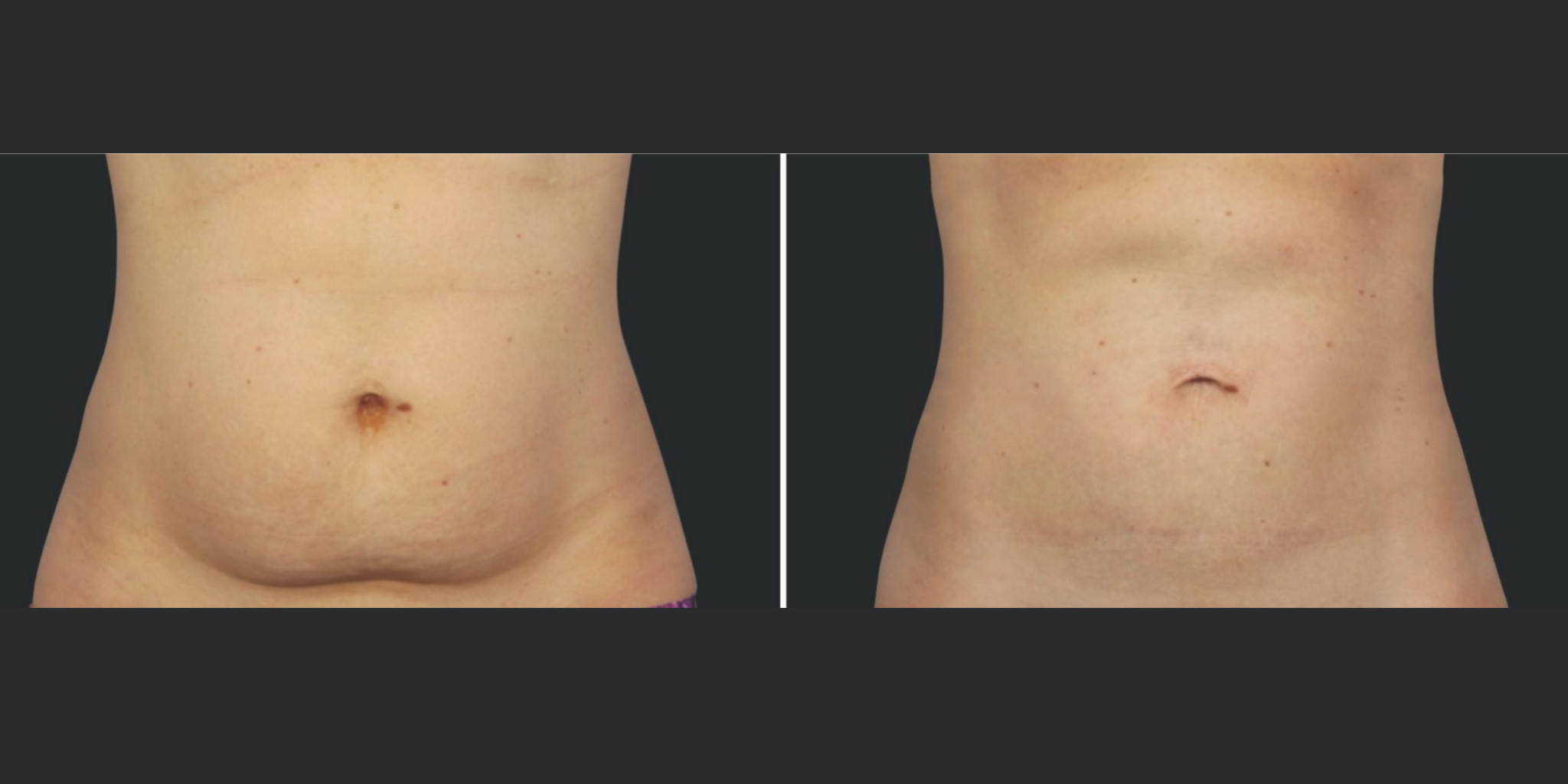 Coolsculpting Elite VS Coolsculpting What’s the Difference? Skinic