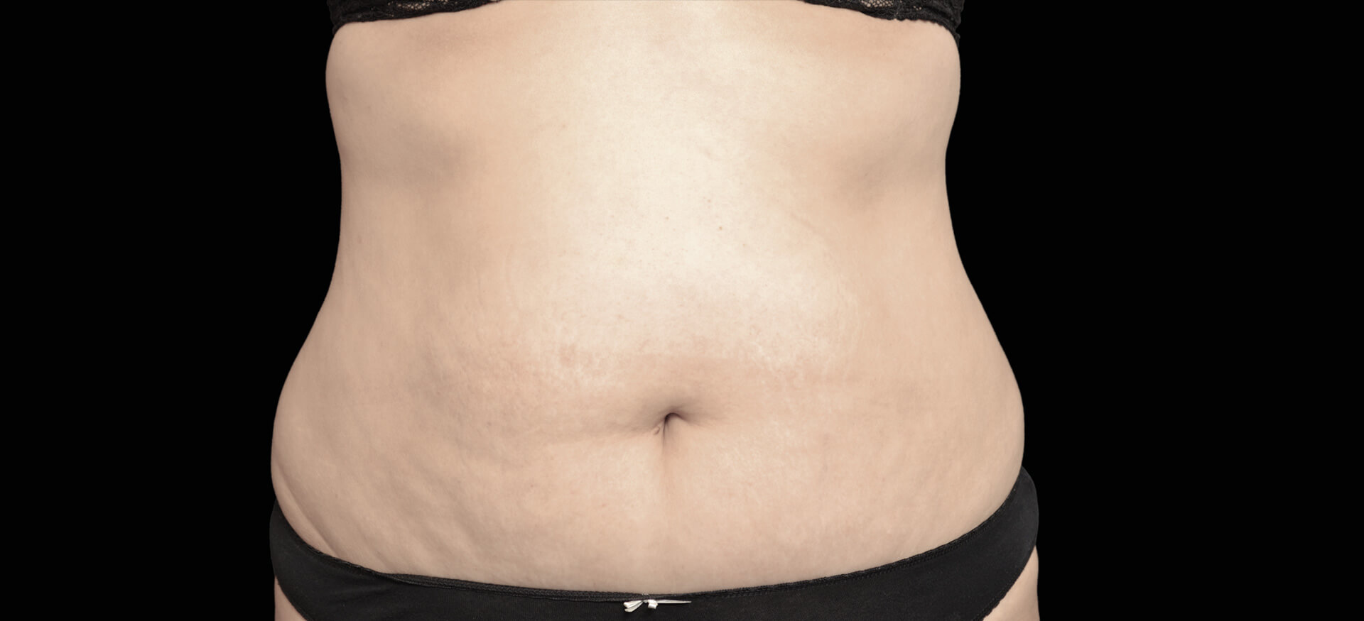 CoolSculpting Stomach Skin Tightening Procedures in Beverly Hills