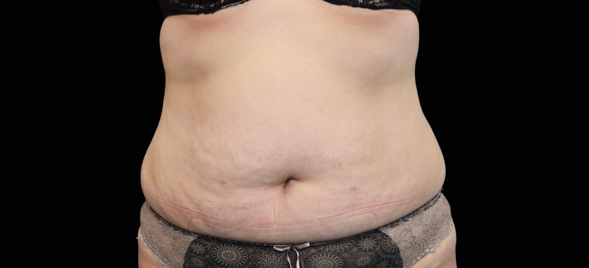 EXILIS Stomach Skin Tightening - £99